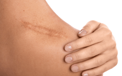 Scars and VA Disability Compensation